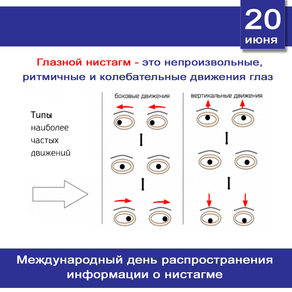 День распространения информации о нистагме | 20.06.2023 | Мичуринск -  БезФормата